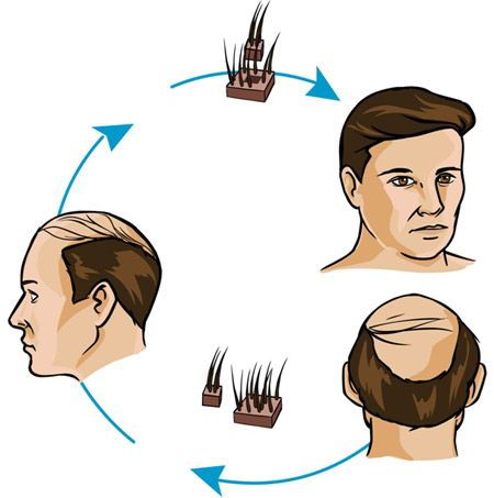 Hair Transplant Centers In Indore