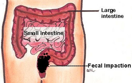 Fekalas Impaction