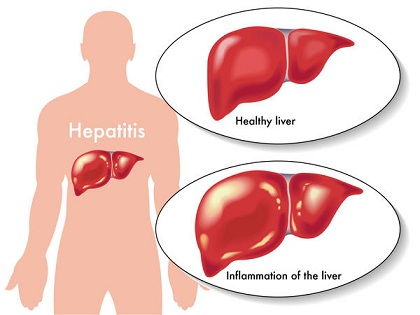 jelek of fatty liver liver inflammation