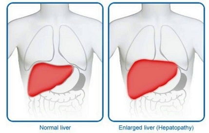 zsíros liver symptoms liver enlargement