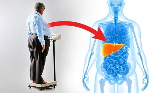 elhízottság causes of fatty liver 