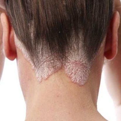 Seborėja Dermatitis Hair Loss