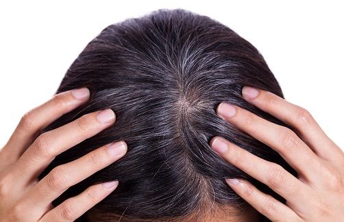 premature greying of hair