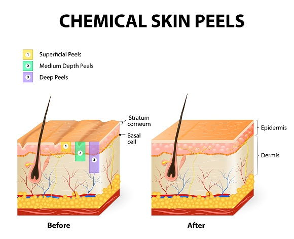 Cheminis skin peeling