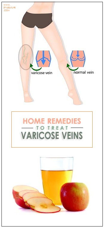 home remedies for varicose veins